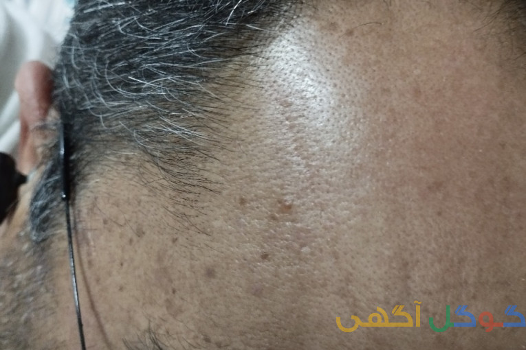 رویش مجدد مو۱۰۰درصدگیاهی 100درصد تضمینی در۳ماه