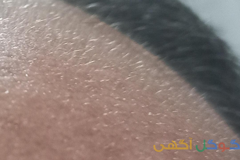 رویش مجدد مو۱۰۰درصدگیاهی 100درصد تضمینی در۳ماه