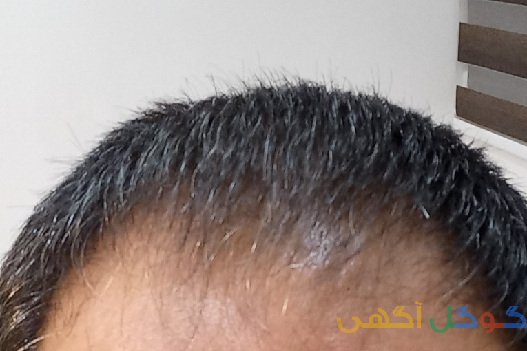رویش مجدد مو۱۰۰درصدگیاهی 100درصد تضمینی در۳ماه