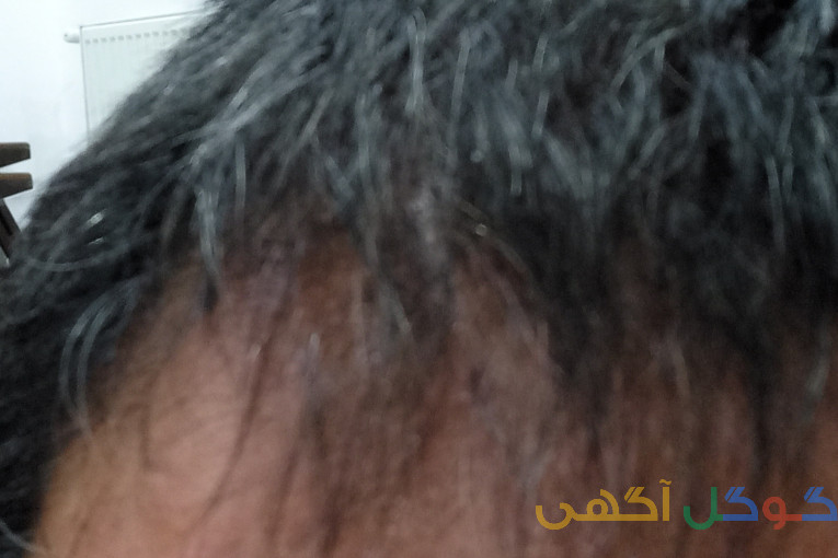 رویش مجدد مو۱۰۰درصدگیاهی 100درصد تضمینی در۳ماه