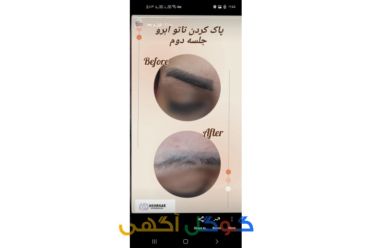 کلینیک تخصصی پاک کردن و ریموو تاتو با لیزرکیوسوئیچ هلیوس و آراف فرکشنال
