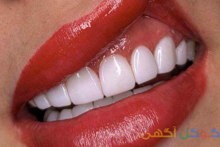 کامپوزیت دندان ایمپلنت لمینت عصب کشی کلینیک ماهانا