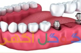 ایمپلنت اقساطی 