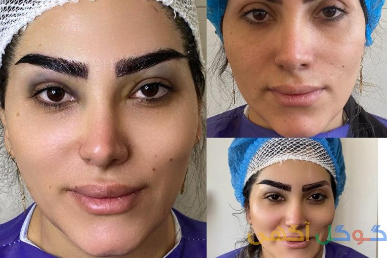 کاشت ابرو جوان