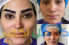 کاشت ابرو جوان