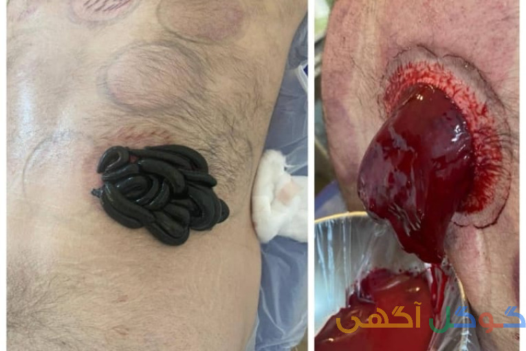 حجامت فصدخون