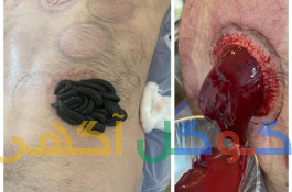 حجامت فصدخون