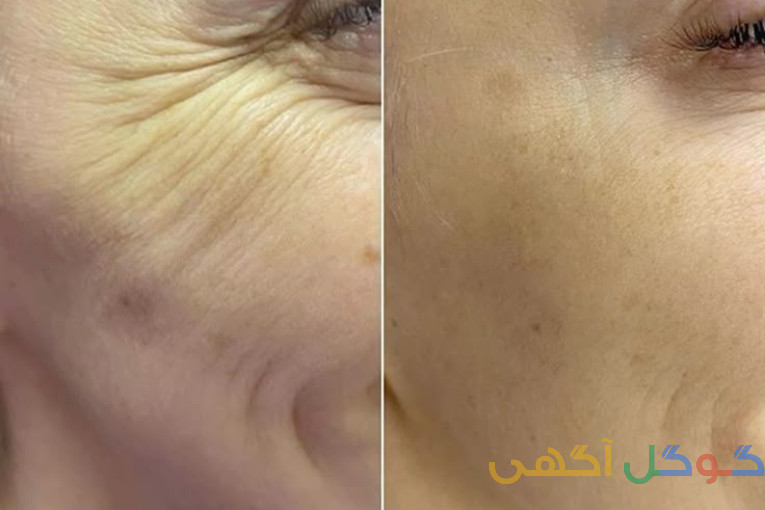 کرم لیفت وجوانسازی صورت 