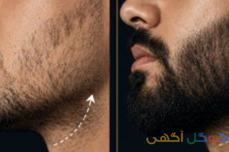رویش ریش ظرف مدت 30روز تضمینی 