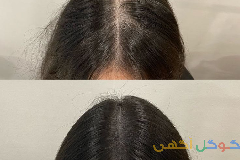 ریزش مو را قبل از دیر شدن متوقف کنید!