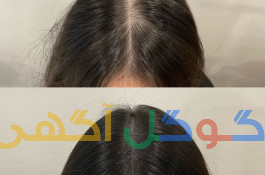 ریزش مو را قبل از دیر شدن متوقف کنید!