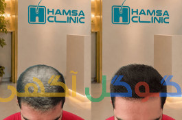 کلینیک کاشت مو همسا